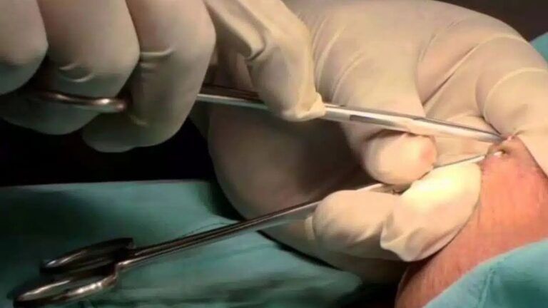 Más de 100 hombres deben esperar dos años por una vasectomía