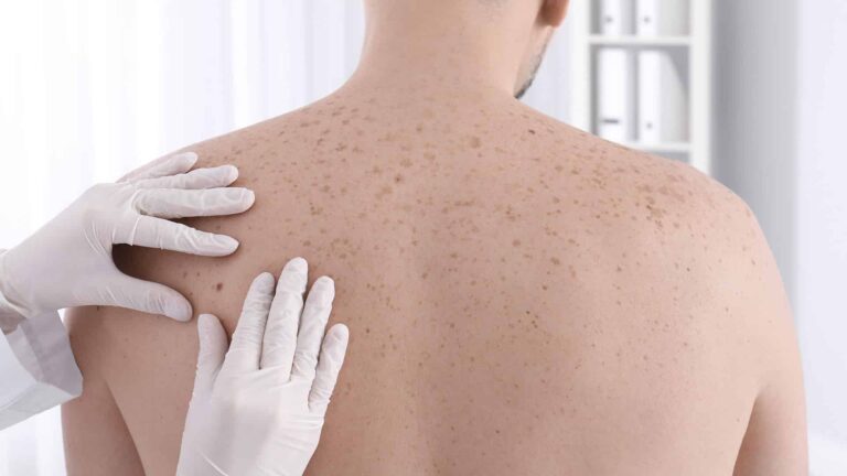 Cáncer de piel: especialistas de Catamarca advierten sobre el aumento de casos