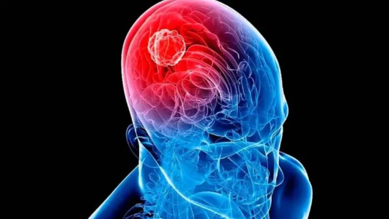 Ilustración de células tumorales cerebrales y tratamiento médico