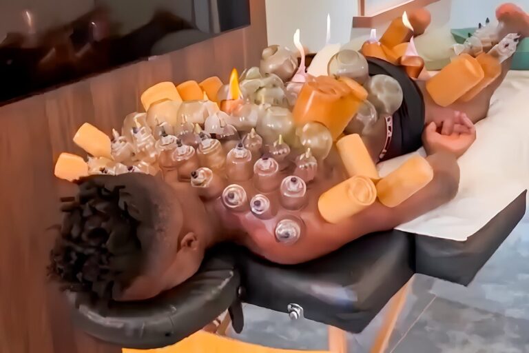 André Onana durante una sesión de cupping con ventosas en la espalda